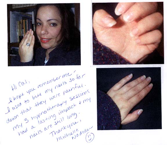 Free From Nail Biting with Hypnosis Testimonial